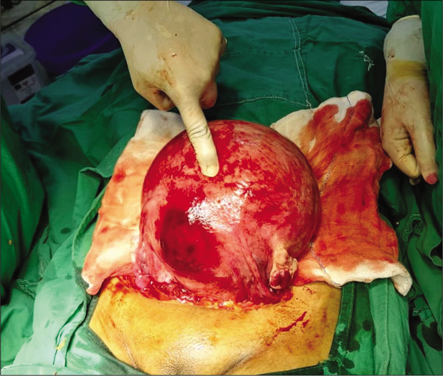 Appearance of the exteriorized uterus after use of vacuum