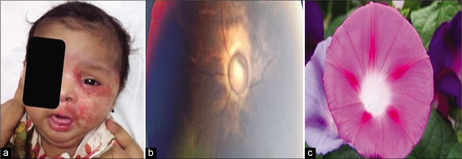 (a) Haemangioma, (b) fundus showing enlarged disc with vasculature, (c) like morning glory.