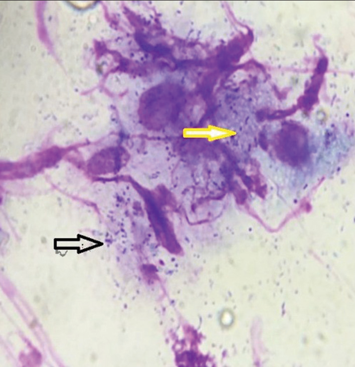 Cytology smear shows intracellular (macrophages) (yellow arrow) and extracellular Donovan bodies (black arrow) (Giemsa stain, 100×).