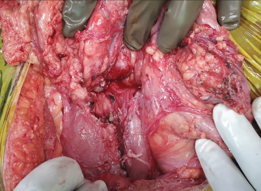 Pancreatic bed after enucleation of the mass.
