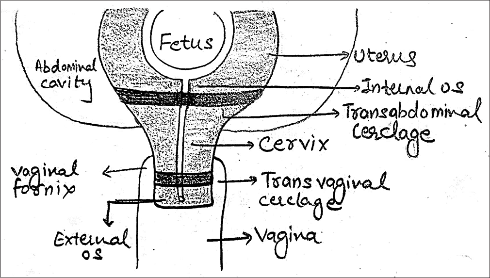 Schematic representation of placement of transabdominal and tranvaginal cerclage.