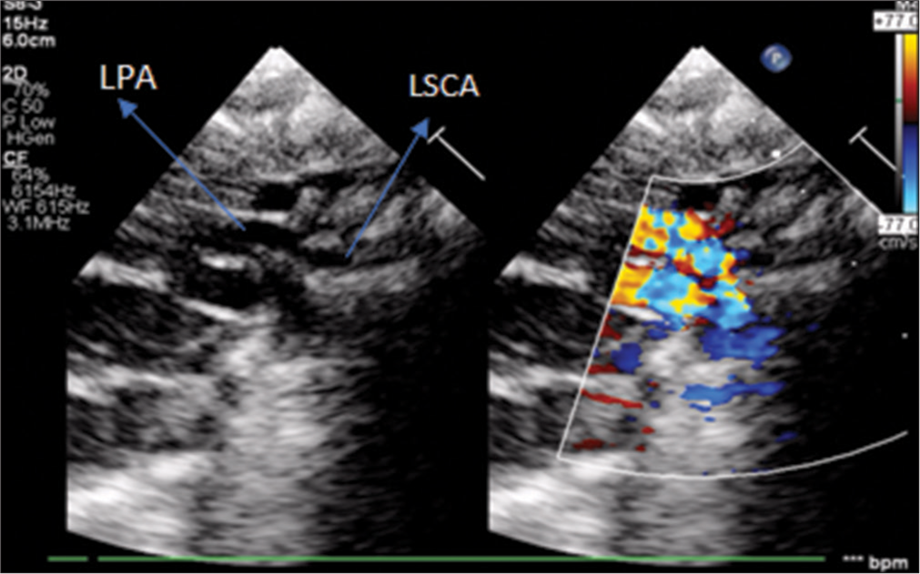 Suspicion of abnormal origin of left subclavian artery from left pulmonary artery with retrograde flow to LPA in 2D echocardiography. LPA: Left pulmonary artery, LSCA: Left subclavian artery.