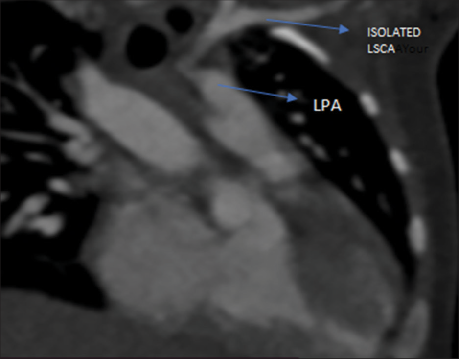 Cardiac CT angio showing isolated left subclavian artery connected to LPA through ductus arteriosus. LPA: Left pulmonary artery, LSCA: Left subclavian artery.