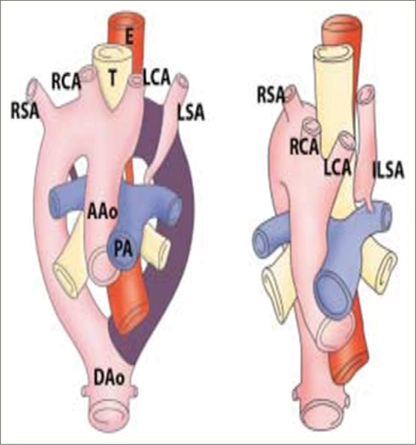 Diagram of development of right aortic arch with isolated left subclavian artery is shown. Anomaly results from interruption of aortic arch at two level one level is between left common carotid and left subclavian arteries and other level is distal to left ductus. Left subclavian artery does not have connection with aorta but is connected to pulmonary artery by left ductus arteriosus. RSA: Right subclavian artery, RCA: Right carotid artery, T: Trachea, LCA: Left common carotid artery, LSA: Left subclavian artery, AA: Ascending aorta, PA: Pulmonary artery, DA: Descending aorta, E: esophagus, ILSA: isolated left subclavian artery.