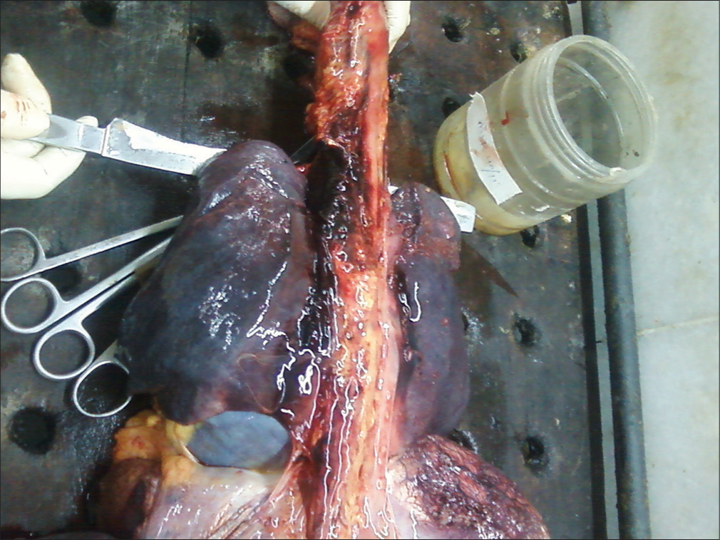 Aortic dissection on post-mortem of sudden maternal collapse.