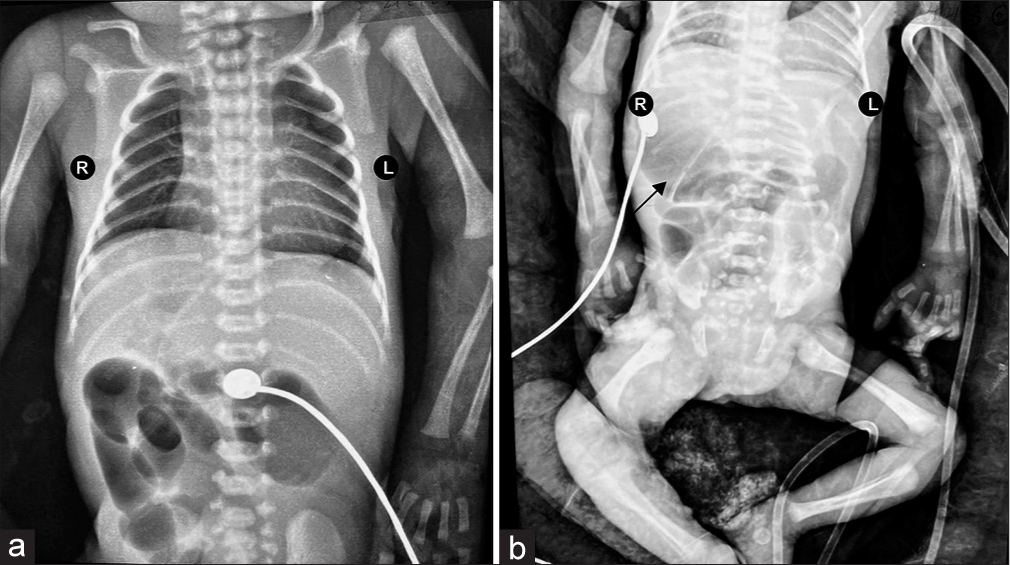 (a) X-ray chest and abdomen AP view showing cardiomegaly with a cardiothoracic ratio of 0.6. (b) Supine X-ray abdomen showing right-sided stomach (black arrow) and absent rectal gas shadow. AP: Antero-posterior.