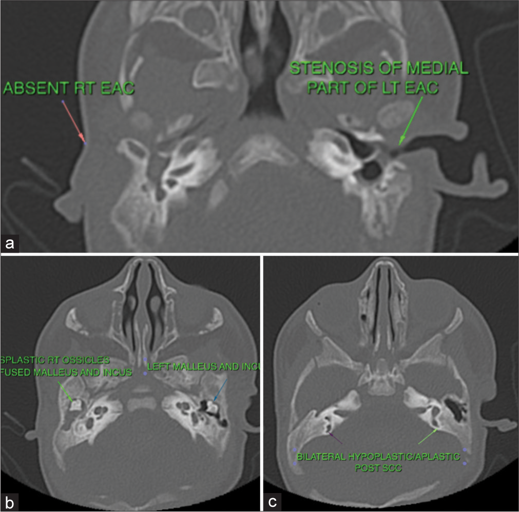 Radiological features (a) bilateral hypoplastic external auditory canal (EAC), (b) dysplasia of middle ear bones, and (c) bilateral hypoplastic semi-circular canals (SCC).