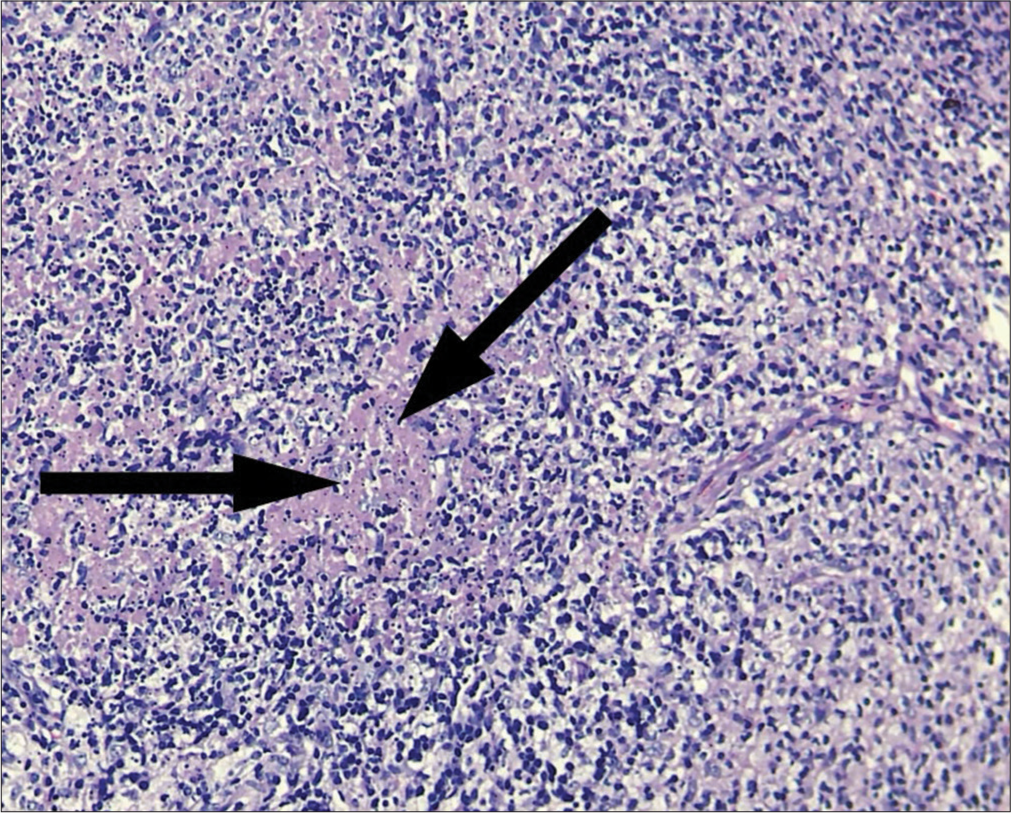 Karyorrhectic debris (black arrows), histiocytes, fibrin deposits, and plasmacytoid monocytes.