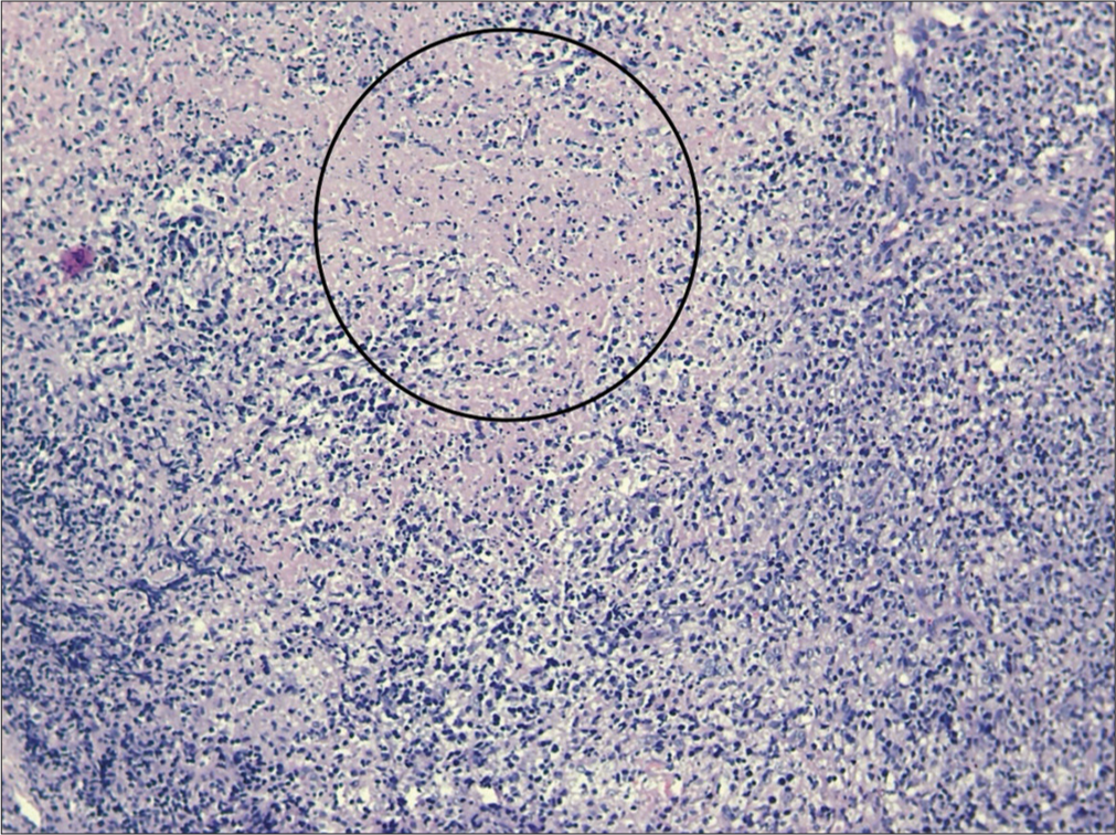 Lymph node histopathology showing pale circumscribed foci of necrotic lesions (inside circle), giving starry sky appearance.