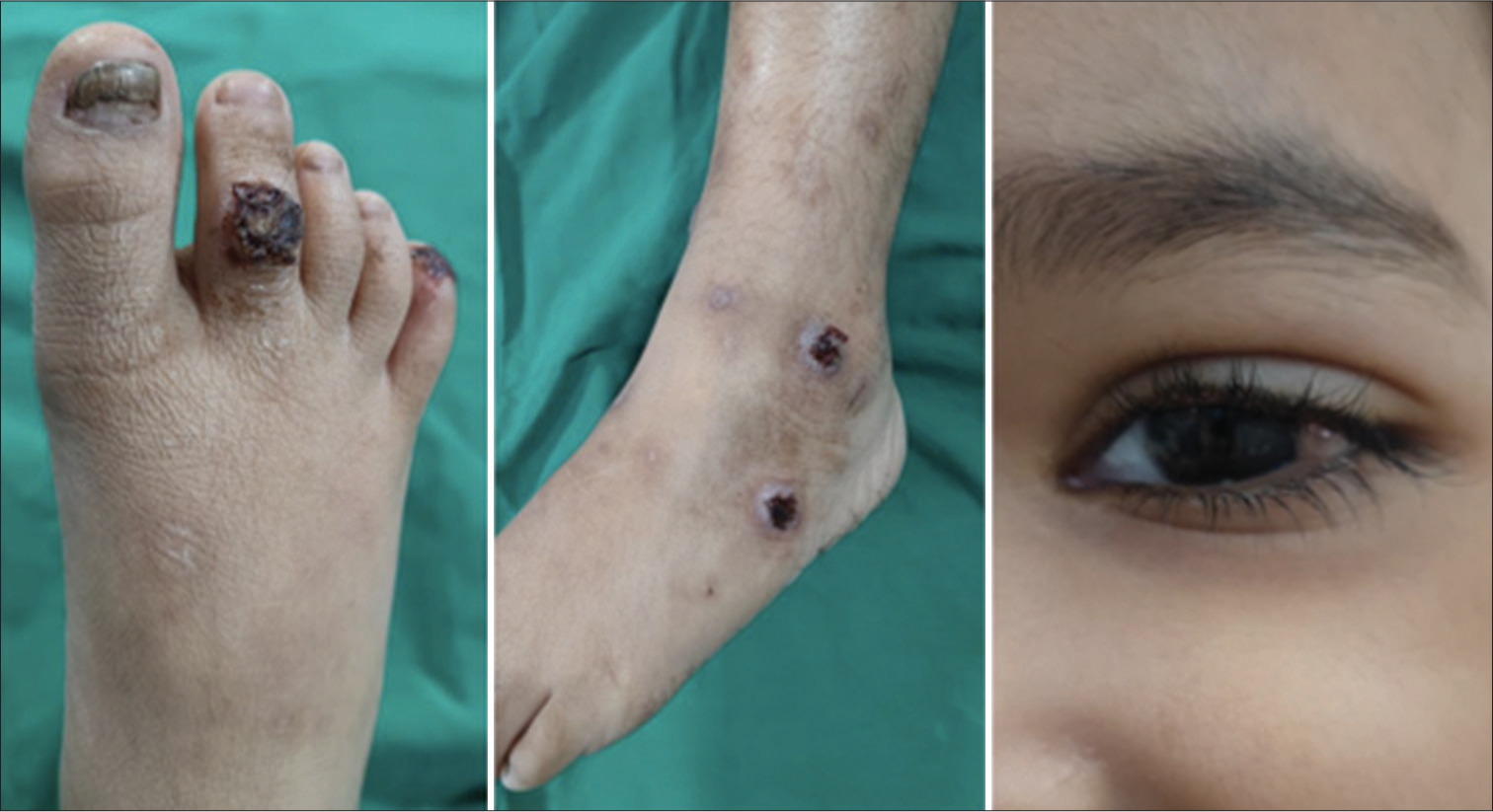 Skin and ocular lesions in our patient with Shabbir syndrome.