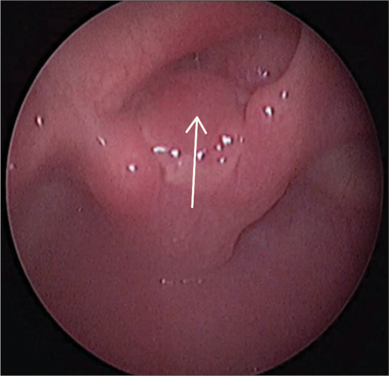 Bronchoscopic image of the laryngeal mass in our patient (shown by arrow).
