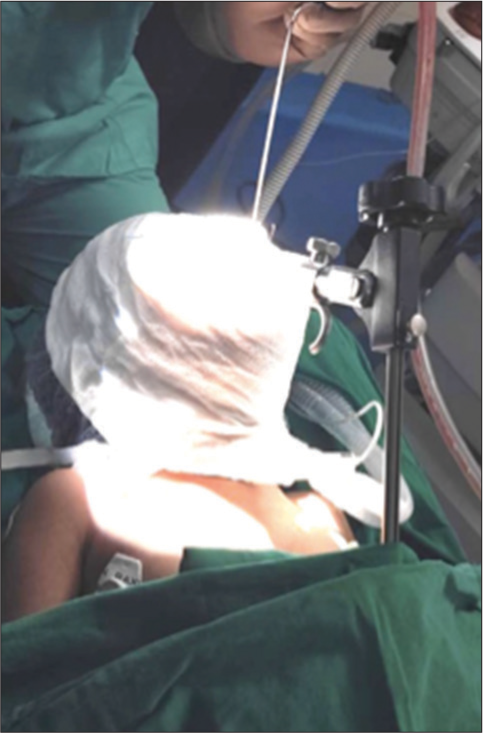 Head and face wrapped with wet mops for laser airway surgery under suspension microlaryngoscope.
