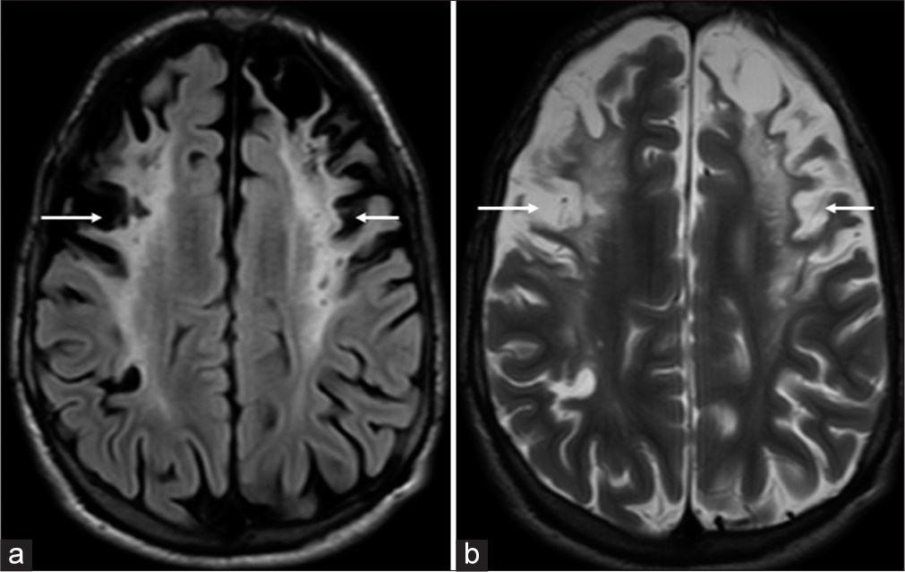 (a) Axial fluid-attenuated inversion recovery and (b) T2-weighted images showing areas of gliosis with encephalomalacia in bilateral frontoparietal lobes (white arrows in a and b).