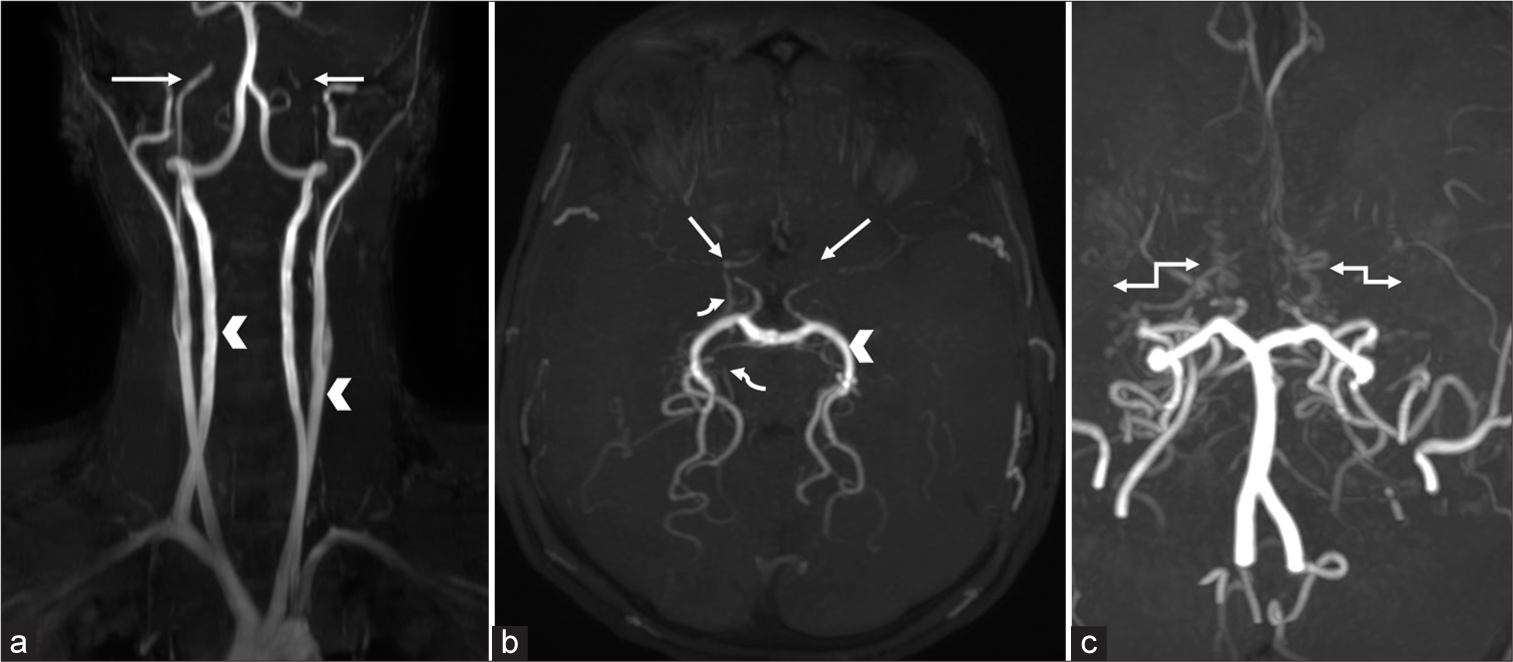 Coronal (a) magnetic resonance time-of-flight angiography of neck show normal vertebral and common carotid arteries (white arrowheads). Bilateral internal carotid arteries are narrowed from origin to throughout entire course with occlusion of terminal segments (white arrows). Axial magnetic resonance time-of-flight angiography of brain (b) shows thin narrowed bilateral middle and anterior cerebral arteries (straight white arrows). Prominent posterior circulation (white arrowhead) and thin basal and perimesencephalic collaterals (curved white arrows) are seen. Coronal magnetic resonance time-of-flight angiography of brain (c) showed thin basal collaterals mimicking “puff of smoke appearance” (double headed white arrows).