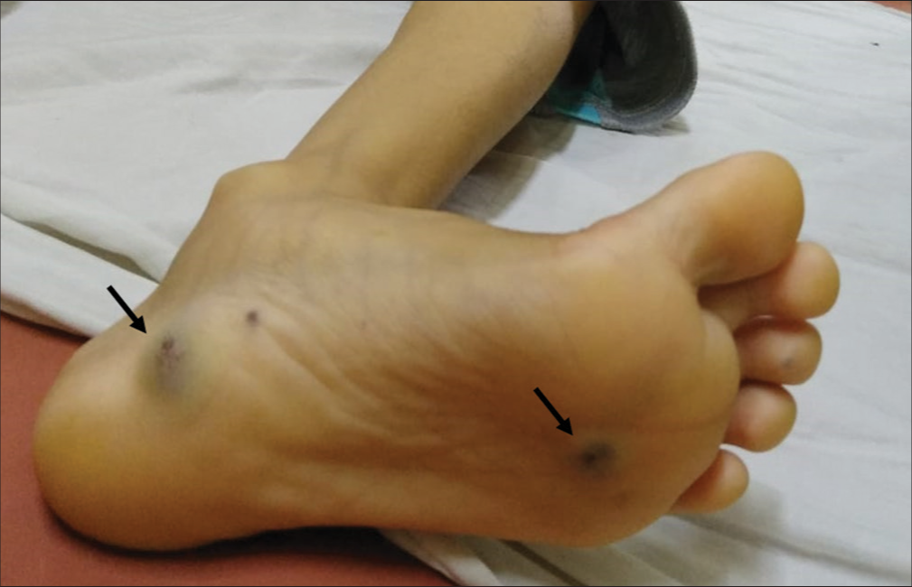 Nevus present as soft, non-mobile, dark blue, compressible papules, as shown by black arrows.