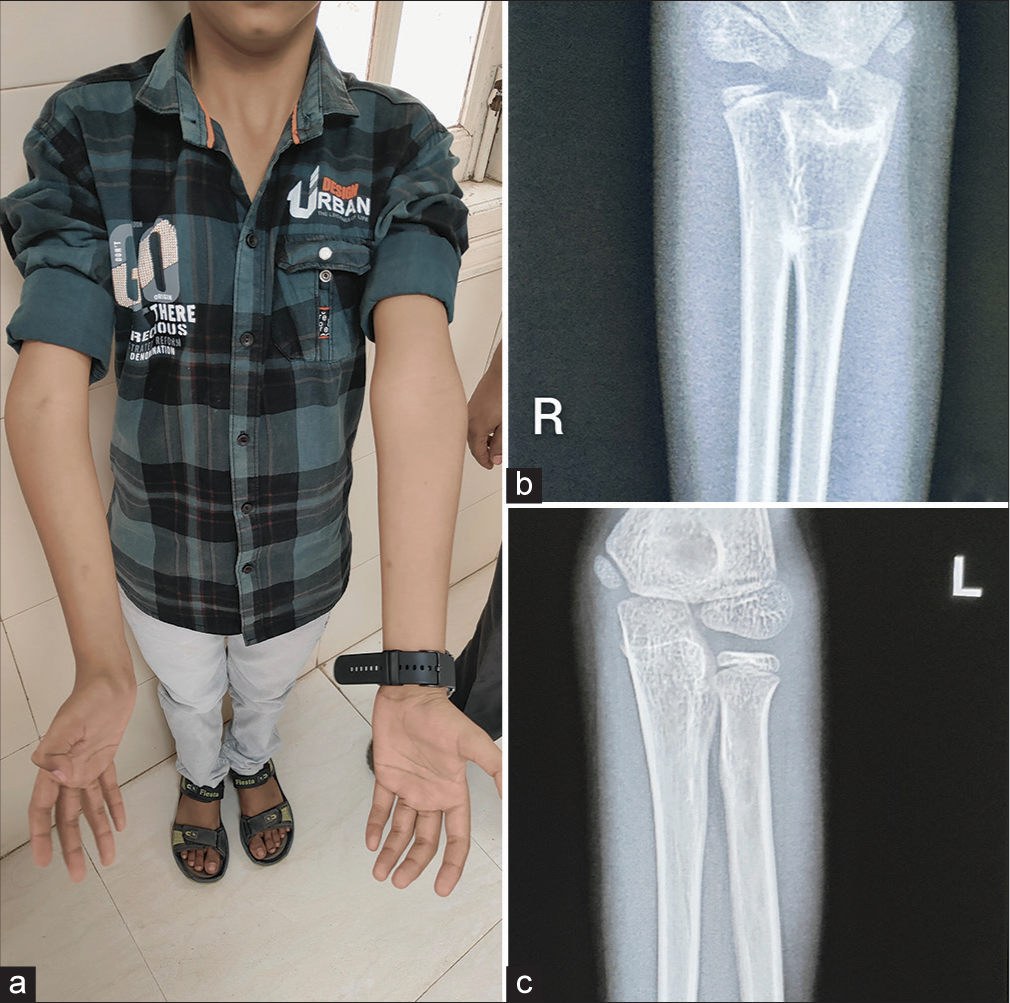 (a) Clinical image of a 9-year-old boy showing varus deformity at right elbow; (b and c) frontal radiograph of right (R) elbow joint showing proximal radioulnar joint synostosis with no such abnormality being noted in left (L) elbow joint radiograph.