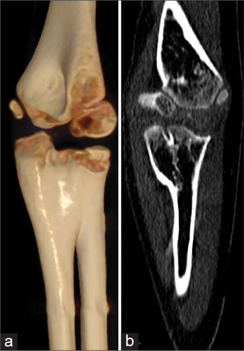 (a) 3D reconstruction; (b) plain computed tomography scan of right elbow showing fusion of radial and ulnar heads with hypoplastic radial head.