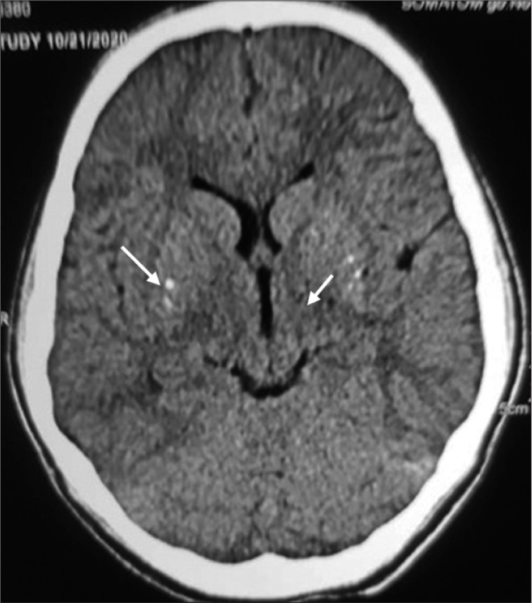 Computed tomography brain cut section showing linear calcifications in Basal ganglia (white arrows).