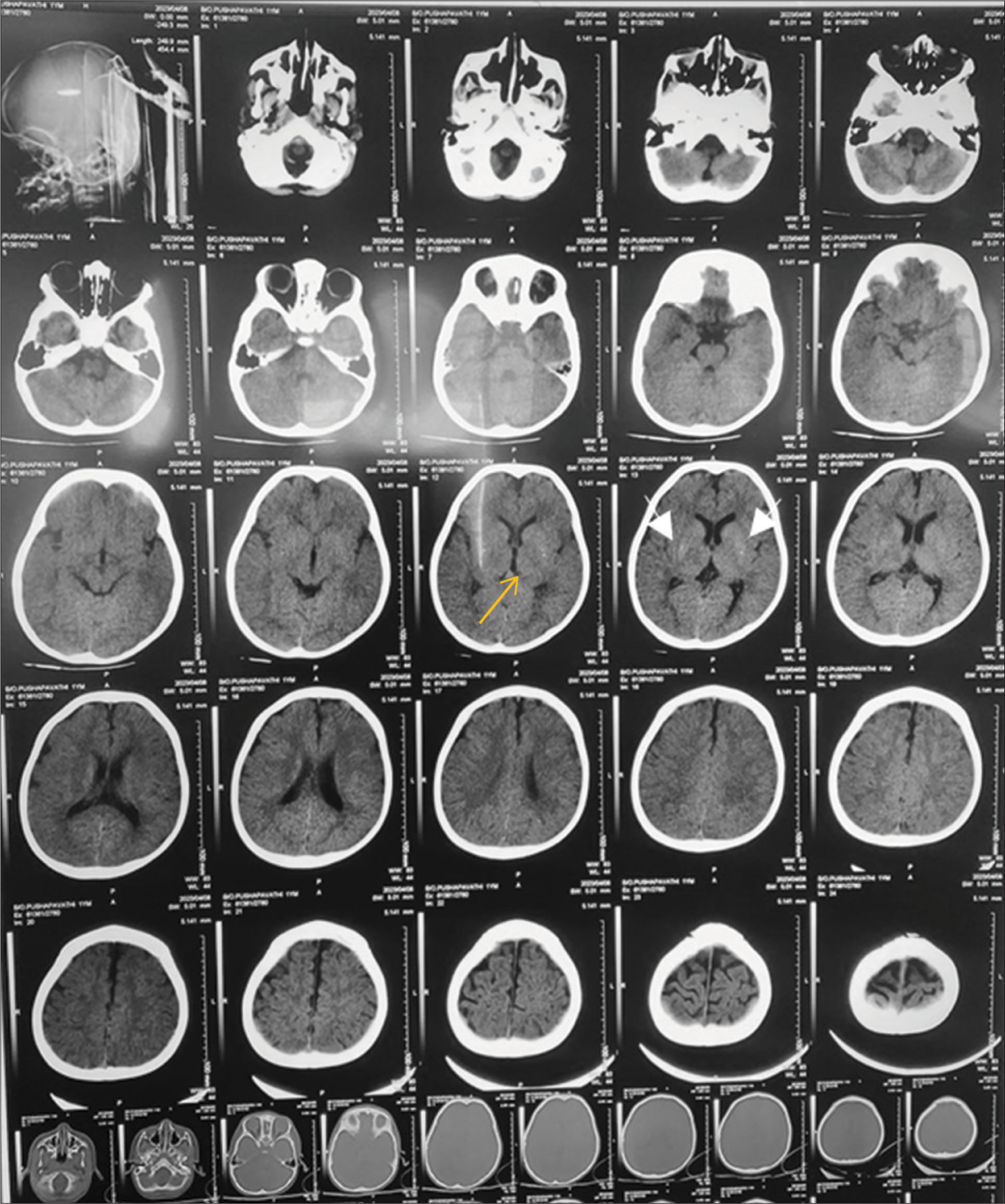 Computed tomography brain showing calcification of lenticulostriate arteries (white arrows) and basal ganglia infarct (yellow arrow).