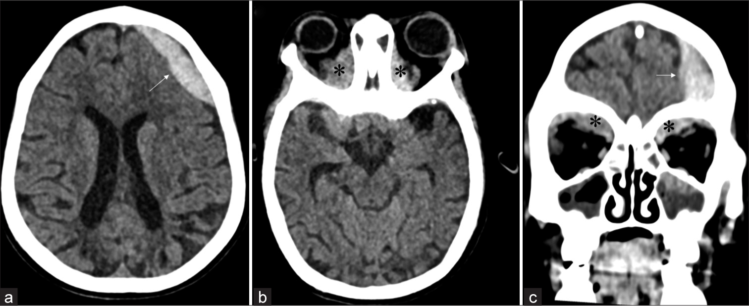 Non-contrast computed tomography (CT) brain in (a) axial plane shows a well-defined extra-axial biconvex shaped lesion (white arrow) of blood attenuation of 12 mm thickness along the left frontal region suggestive of extradural hematoma. Non-contrast CT brain in (b) axial and (c) coronal planes show an extradural hematoma in the left frontal region (white arrow) and two well-defined hyperdense lesions (black asterisks) of blood attenuation measuring 2 × 1.5 × 1 cm on either side in bilateral superior subperiosteal, intraorbital and extraconal fat spaces suggestive of intraorbital hematomas. Bilateral extraocular muscles are normal. No calvarial or orbital bone fracture is seen.