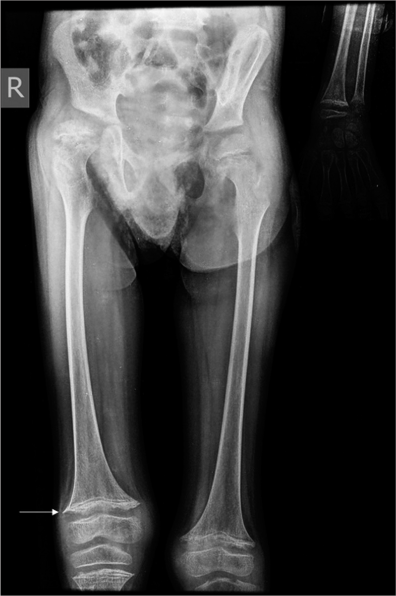 Bilateral thigh radiograph shows osteopenia predominantly in the lower half with cortical thinning and few metaphyseal spurs (white arrow) in both the femurs.