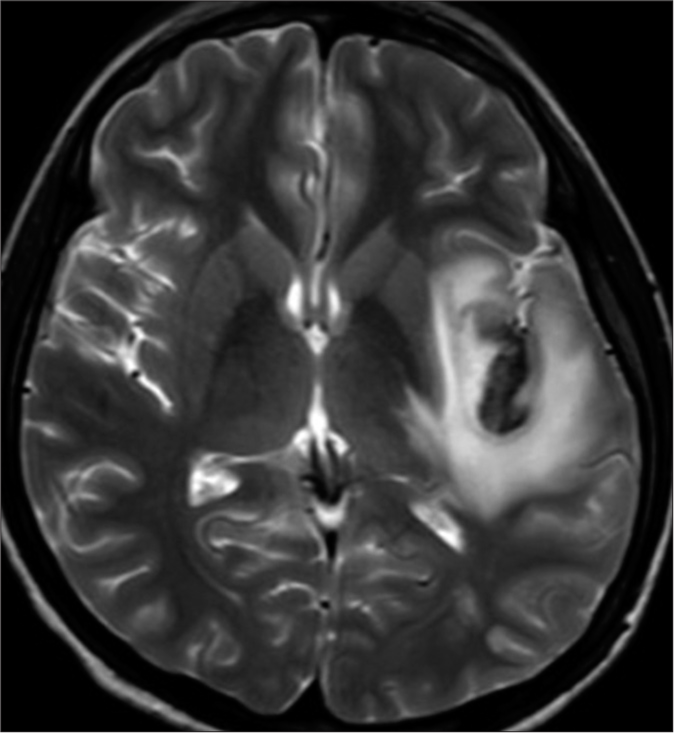 Axial T2-weighted hyperintense lesion with a central dark area in the left insular cortex with perilesional edema.