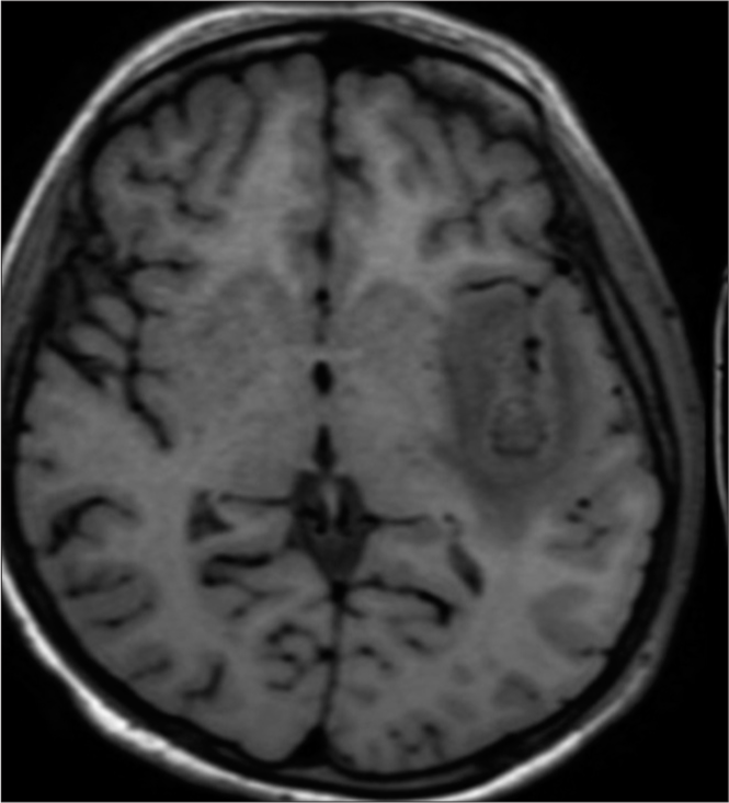 Axial T1-weighted hypointense lesion in the left insular cortex.