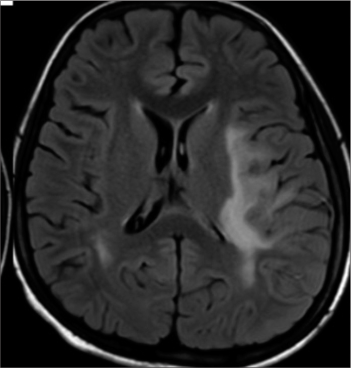 Axial fluid-attenuated inversion recovery extension of perilesional edema into left thalamus and posterior limb of internal capsule.