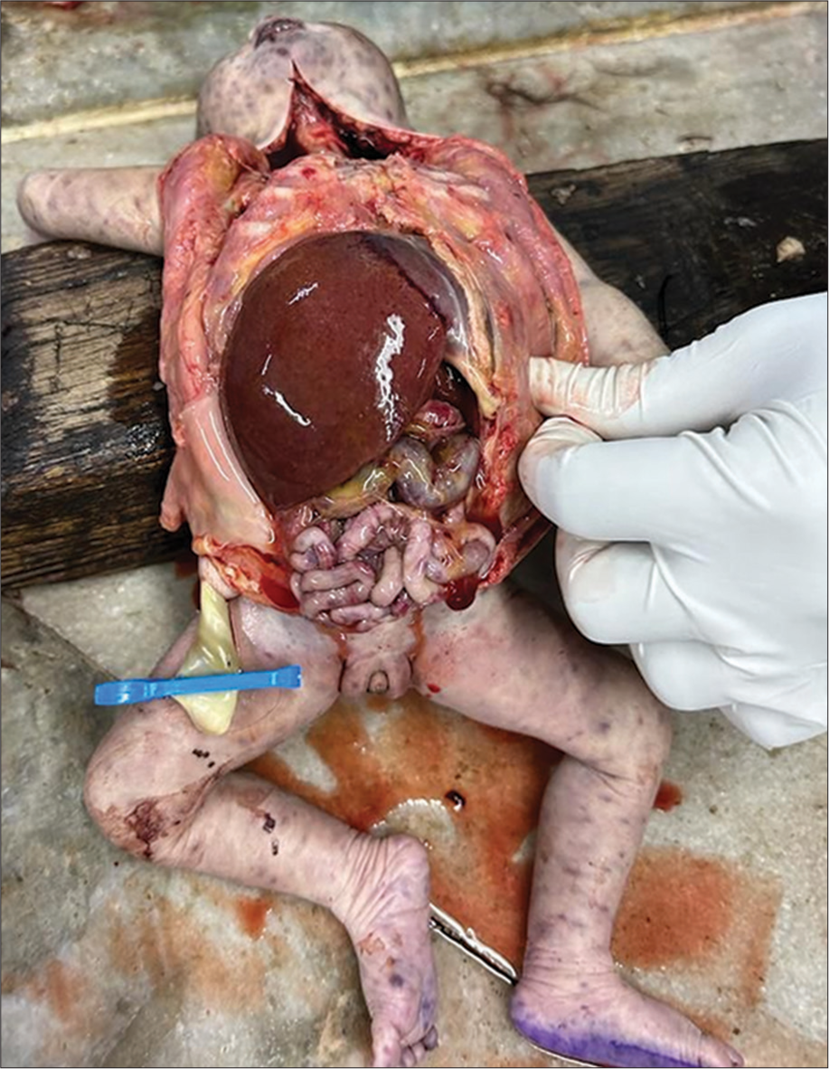 Fetal autopsy confirming gross hepatosplenomegaly.