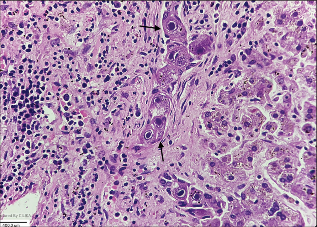 Bile duct epithelium shows cytomegaly and the characteristic “owl eye” intranuclear inclusions (black arrows) (Hematoxylin and eosin (HE), × 400).