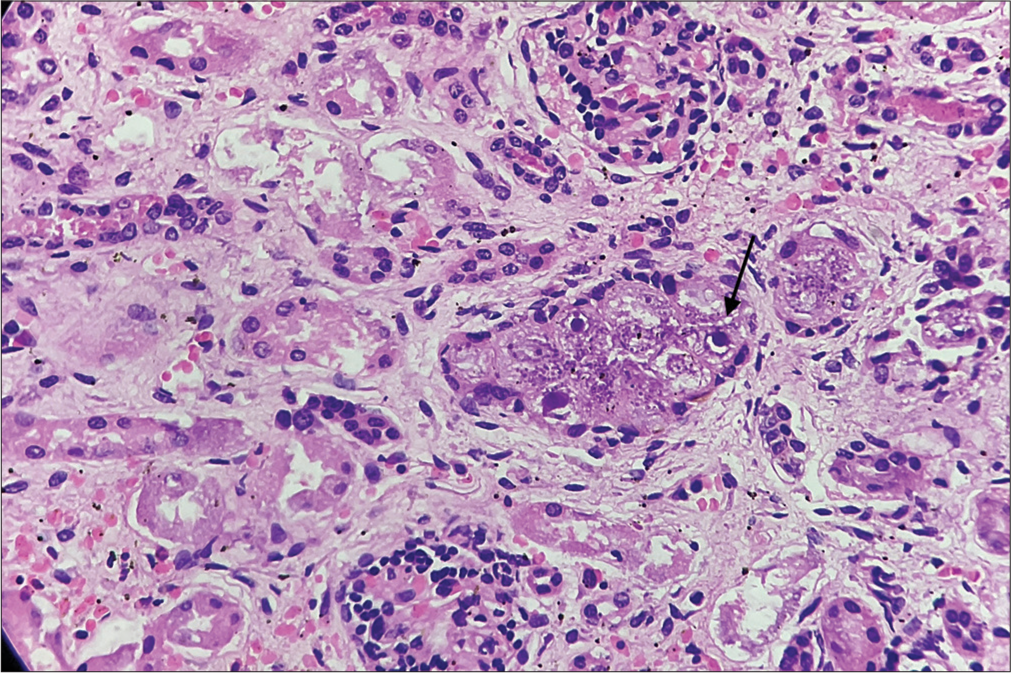 Renal tubular epithelium shows cytomegaly and the characteristic “owl eye” intranuclear inclusions (black arrow) (Hematoxylin and eosin (HE), ×400).