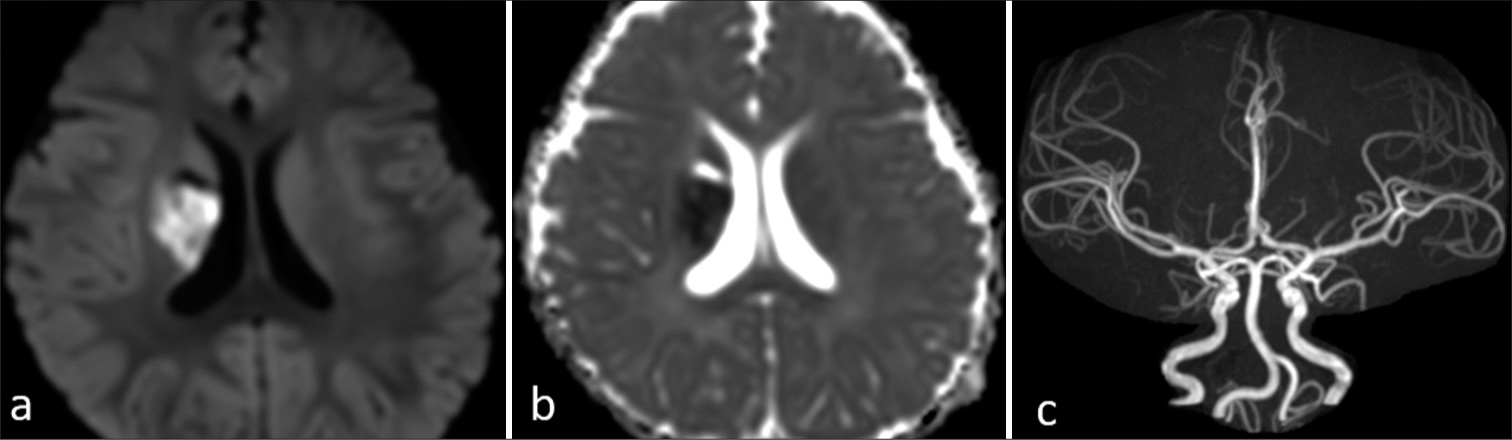 (a) Axial diffusion and (b) apparent diffusion coefficient images show acute infarct in the right lentiform nucleus. (c) Time-of-flight magnetic resonance angiogram shows normal signal in intracranial vasculature with no major vessel occlusion.