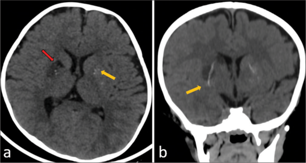 (a) Unenhanced axial and (b) coronal reformatted maximum intensity projection computed tomography images of the brain show linear calcification along the lenticulostriate arteries on both sides (yellow arrows in a and b) and hypodense infarct in the right lentiform nucleus (red arrow in a).