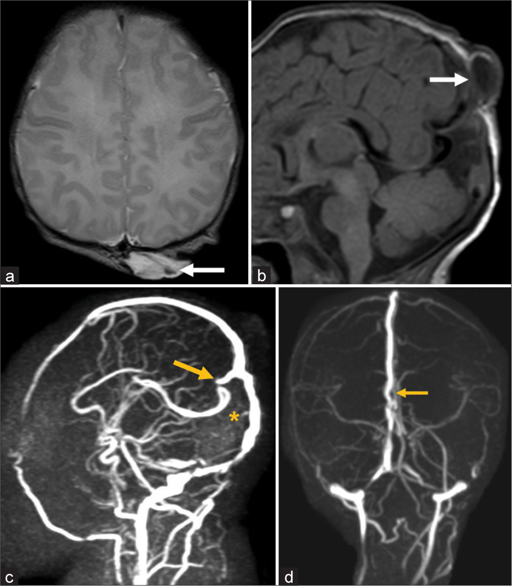 (a) Axial T2-weighted magnetic resonance imaging (MRI) shows cystic subcutaneous lesion near vertex with internal hypointense band (fibrous content - white arrow), (b) Sagittal T1-weighted MRI image shows calvarial defect in parietal bone (white arrow) with cystic subcutaneous lesion, (c) Magnetic resonance (MR) venography shows vertically oriented persistent falcine sinus (yellow arrow), absent straight sinus (yellow asterix in normal location of straight sinus), (d) Coronal plane of MR venography shows focal fenestration of superior sagittal sinus at the site of atretic parietal cephalocele. Focal fenestration in superior sagittal sinus (yellow arrow).