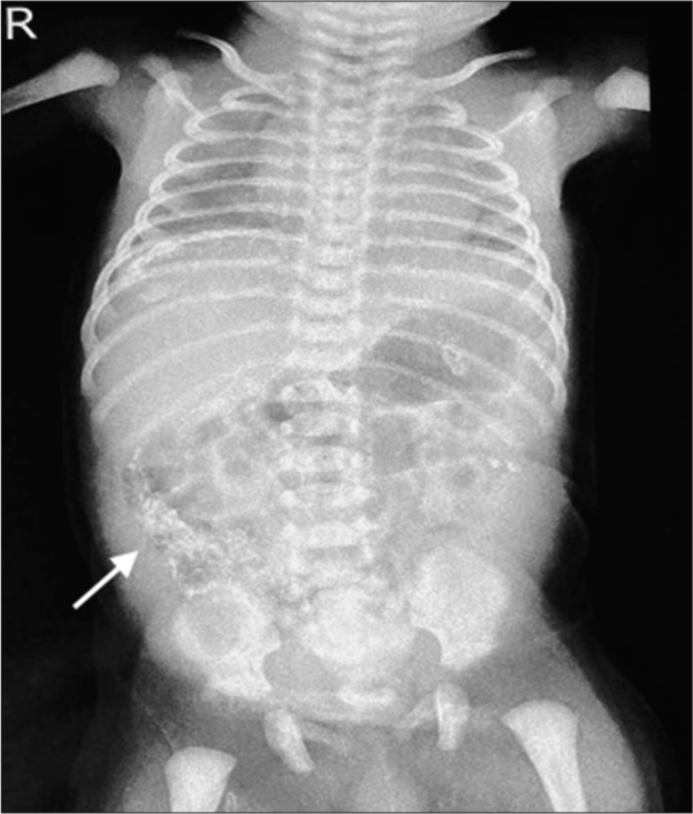 Fleets of intra-abdominal calcification (white arrow) on postnatal day 1.