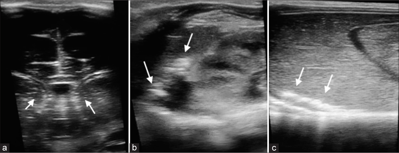 Ultrasound images demonstrating calcification (white arrows). (a) Periventricular calcification with multiple calcifications along the vessels within the thalami, (b) renal calcifications, and (c) hepatic calcifications on postnatal day 2.