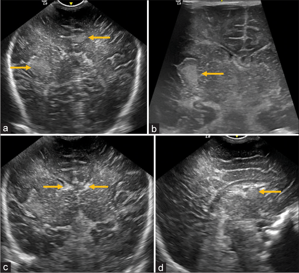 Neurosonogram (a and b) coronal sections show well-defined cortical-subcortical echogenic lesions suggestive of tubers (yellow arrows), (c) coronal section shows tiny echogenic lesion in the frontal horn of both lateral ventricle suggestive of subependymal nodules (yellow arrows), and (d) sagittal section shows well-defined echogenic lesion at foramen of Monroe suggestive of subependymal giant cell astrocytoma (subependymal giant cell astrocytoma (SEGA)-yellow arrow).