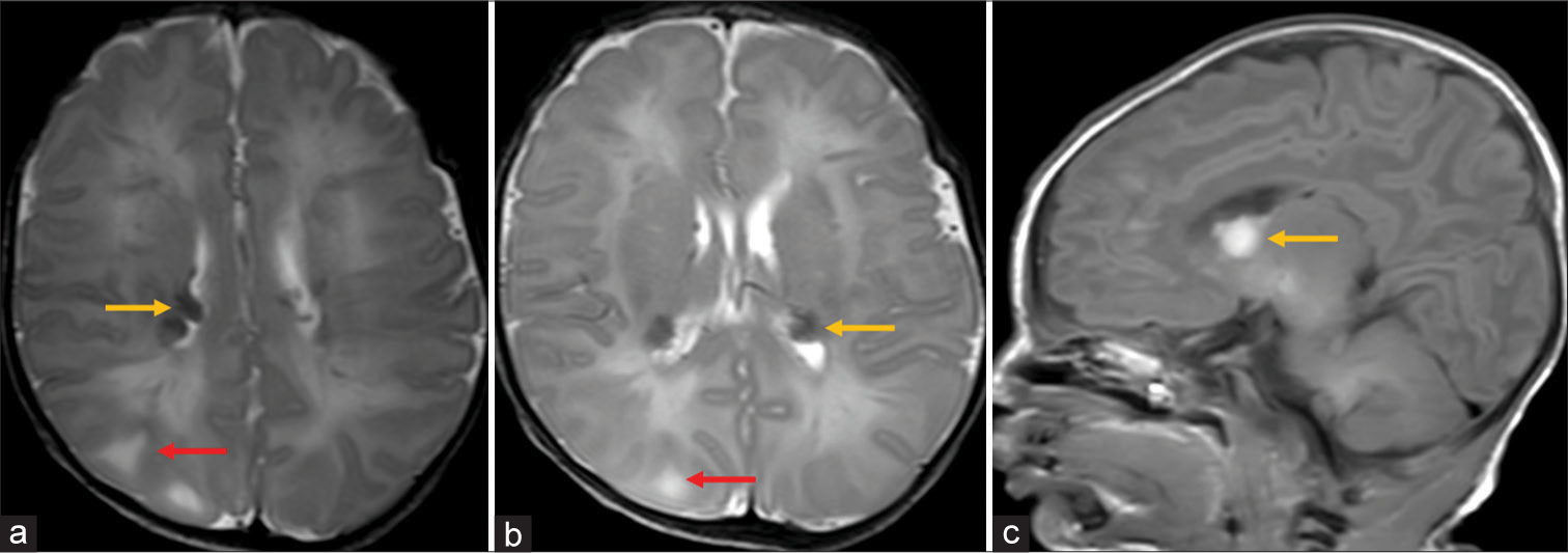 (a) Axial T2-weighed image shows cortical-subcortical tubers (red arrow) and hypointense subependymal nodules (yellow arrow), (b) axial T2-weighted image shows well-defined hypointense subependymal nodules (yellow arrow) and cortical tuber (red arrow), and (c) sagittal T1-weighted image show hyperintense subependymal giant cell astrocytoma (Subependymal giant cell astrocytoma (SEGA) yellow arrow).