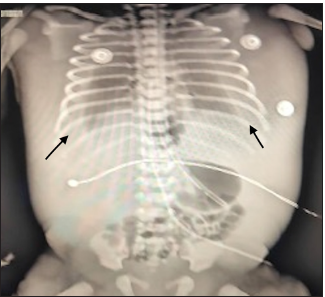 X-ray showing bilateral pleural effusion (black arrows).