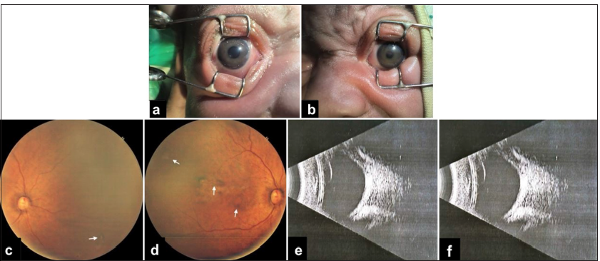 (a) Anisocoria with the right eye showed a pupillary dilatation of 3 mm, (b) The left pupillary dilatation of up to one mm. (c) Fundus examination of right eye: Small scars in the nasal retina (white arrow), (d) Fundus examination of left eye: large chorioretinal scar sparing the macula with multiple small scars in the nasal and temporal fundus (white arrows). (e) B scan with no evidence of vitreitis in right eye, (f) B scan with no evidence of vitreitis in left eye.