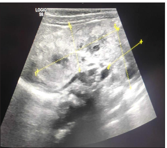 Crossed-fused ectopic kidney USG. Yellow dot lines are demarking and showing the crossed fused ectopic kidney. USG: Ultrasonography.